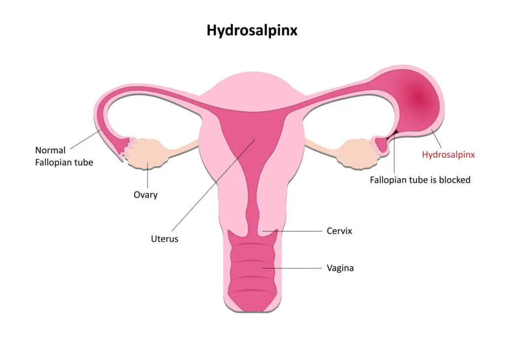 Hydrosalpinx: Causes, Symptoms, and Treatment Options