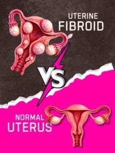 Uterine Fibroid