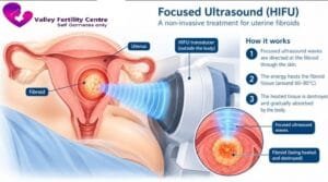 HIFU treatment for uterine fibroids